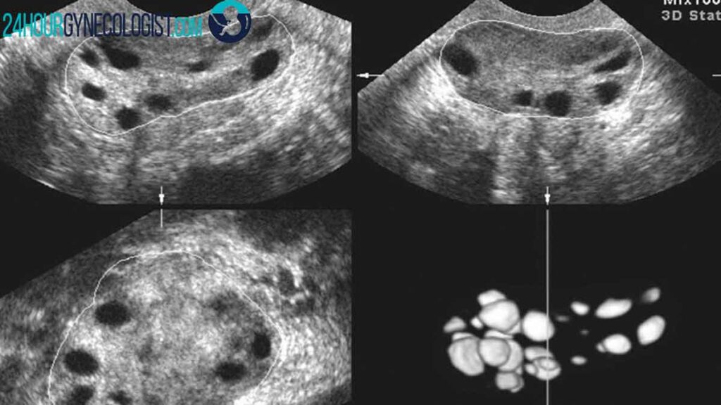 علائم تنبلی تخمدان در سونوگرافی